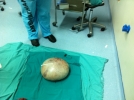 Bir ameliyatta 12 kilo verdi